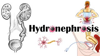 Hydronephrosis  Definition Functional Anatomy Causes Signs amp Symptoms Diagnosis amp Treatment [upl. by Venola]