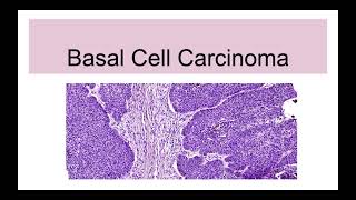 Basal Cell Carcinoma Etiopathogenesis and Morphology [upl. by Fabrianna]