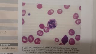 Megaloblastic Anemia  SPECIAL PATHOLOGY [upl. by Pooh]