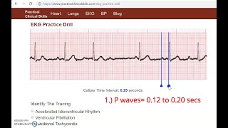 Guess That Rhythm 2nd degree Type I Heart Block [upl. by Jyoti952]