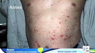 Psoriasis Testimonios con Nopsor [upl. by Lasiaf484]