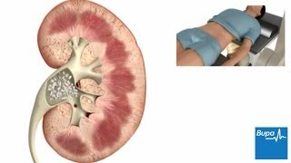 How extracorporeal shockwave lithotripsy is used to treat kidney stones  Bupa Health [upl. by Naired]