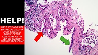 Atypical cells suspicious for adenocarcinoma AAH AIS [upl. by Nedlog]