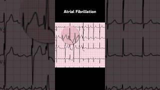 Atrial Fibrillation ECG Ashman phenomenon [upl. by Zoarah756]