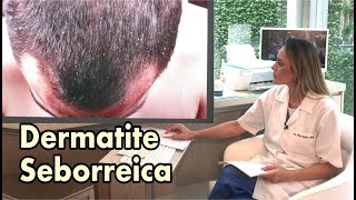 Dermatite Seborreica e Caspa  Conheça as diferenças [upl. by Dloreg673]