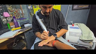 150 किमी से आयै है भैया  Laser Tattoo Remova Karane  NAME  OM TATTOO LASER REMOVAL 4k removal [upl. by Animlehliw]