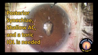 Cataract Surgery with Lysis of Posterior Synechiae and Pupil Restoration [upl. by Kanya]