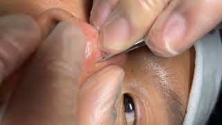 White blackheads on nose  acne pimple remove  how to remove blackheads from forehead [upl. by Verras770]