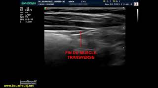 Quadratus lumborum QLB block [upl. by Aria319]