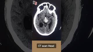 Bleed in Ganglio thalamic region bleed ctscan radiology brain [upl. by Rosenblum787]