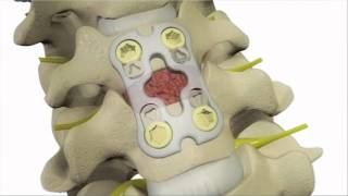 Anterior Cervical Discectomy and Fusion  DePuy Videos [upl. by Jentoft]