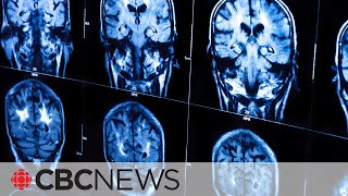 PHAC deploying to NB over reports of mystery brain symptoms [upl. by Ahsille222]