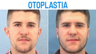 Otoplastia Masculina Antes y Después  Clínicas Diego de León [upl. by Tham235]