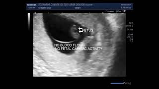 Early twin pregnancy with one blighted ovum and other missed abortion [upl. by Froh]