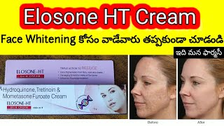 elosone ht cream uses in telugu  hyperpigmentation cream how to apply how many days precautions [upl. by Clementis]