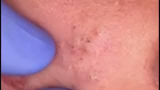 how to get rid of comedones on face  how to remove blackheads from nose [upl. by Rawdon]