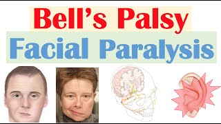 Bell’s Palsy Facial Paralysis  Causes Pathophysiology Signs amp Symptoms Diagnosis Treatment [upl. by Wootan]