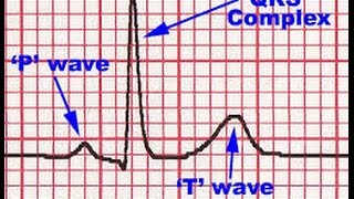 ECG QRS complex [upl. by Nimref]