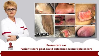 Prezentare caz  Pacient stare postcovid extrernat cu multiple escare  Promo medatalos nursery [upl. by Chappie]