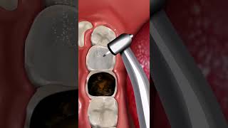 ASMR Molar Tooth Removal amp Dental Cleaning amp Pulp Removal shorts asmr relax dentalcare [upl. by Gaeta]