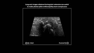 Plantar plate enthesopathy on dynamic foot ultrasound [upl. by Ayekal390]