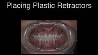 Placing Plastic Dental Retractors [upl. by Tine]