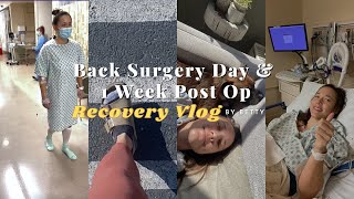 L5S1 Laminectomy  Microdiscectomy Surgery Day amp 1 Week Post Op  Recovery by Betty [upl. by Marnie772]