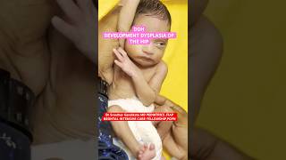 How to check DDH in Newborn babies pediatrics newborn nicujourney drsreedhargandikota [upl. by Ratib541]