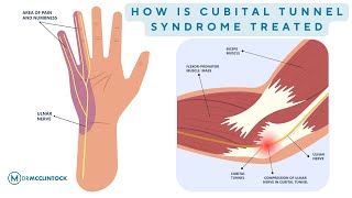 How Is Cubital Tunnel Syndrome Treated  Dr Kyle McClintock [upl. by Mesics255]