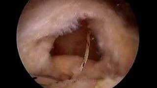 Arthroscopic Rotator Cuff Repair  Medium Supraspinatus Tear [upl. by Horwitz514]