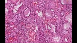 Histopathology KidneyArteriolosclerosis hypertension an [upl. by Hanshaw]