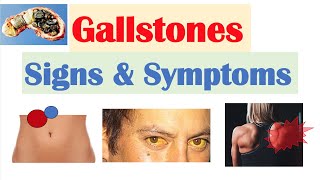 Gallstones Signs amp Symptoms Why They Occur  Cholecystitis Choledocholithiasis Cholangitis [upl. by Ysirhc]