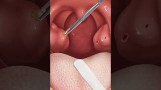 ASMR remove tonsil stone treatment Tonsil stone removal from deep hole 2d animation [upl. by Noakes]