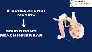 WHAT IS OTOSCLEROSIS [upl. by Ettolrahs]