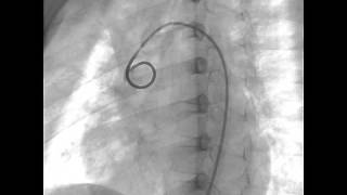 COARTACION AORTA 1 de 3 [upl. by Monia]