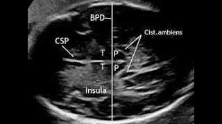 How to measure Biparietal diameter by Ultrasonography [upl. by Aerdnad336]