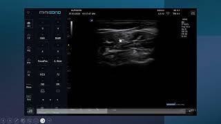 Ultrasound guided Interscalene brachial plexus nerve block [upl. by Minda]