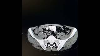 Tuberculosis involving terminal ileum ileocecal junction caecum and ascending colon [upl. by Nalhsa]