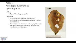 Kidney Xanthogranulomatous pyelonephritis Gross pathology [upl. by Joana]