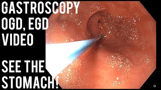 Gastroscopy  OGD  See inside the stomach [upl. by Tnahsarp]