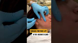 Threads for face lift Treatment at DrKasana s [upl. by Kartis]