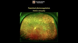 Panretinal photocoagulation Diabetic retinopathy [upl. by Blaseio]