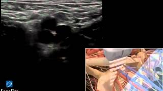 3D Cómo hacer Inserción ecoguiada de Catéter en Vena Femoral  Ultrasonido SonoSite [upl. by Sherurd794]