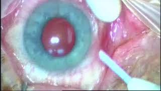 Intravitreal Ozurdex Implant [upl. by Schonfield400]