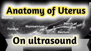 Sonographic Anatomy of UterusGyneacological ultrasound [upl. by Wrdna]