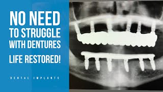 No need to struggle with dentures life restored [upl. by Paradies]