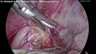 Myomectomy from anterior rectal wall [upl. by Pronty]