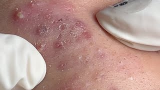 Acne Treatment Huong Da Nang 595  2024 [upl. by Aicenav]