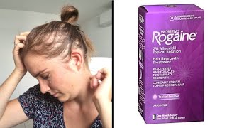 MINOXIDILROGAINE amp ALOPECIA My 10 years treatment experience review [upl. by Schnorr895]