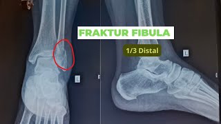 Fraktur Fibula 13 Distal [upl. by Anitnauq]